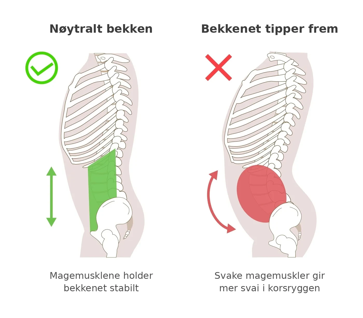 Illustrasjon av et nøytralt bekken med stabile magemuskler, og et bekken som tipper frem med svai i korsryggen når magemusklene er svake