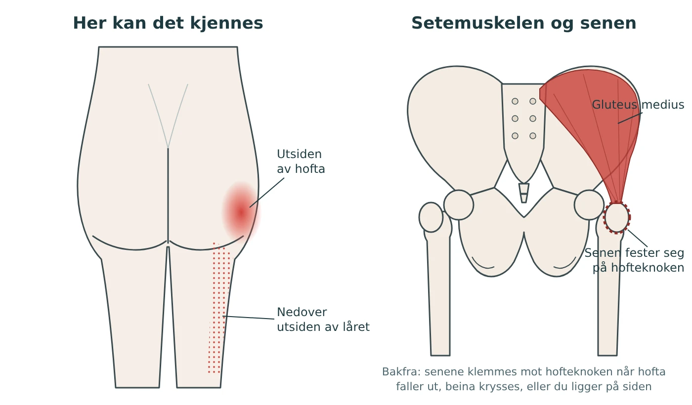 Illustrasjon av gluteus medius bakfra, og hvor smerten kan kjennes på utsiden av hofta og nedover utsiden av låret