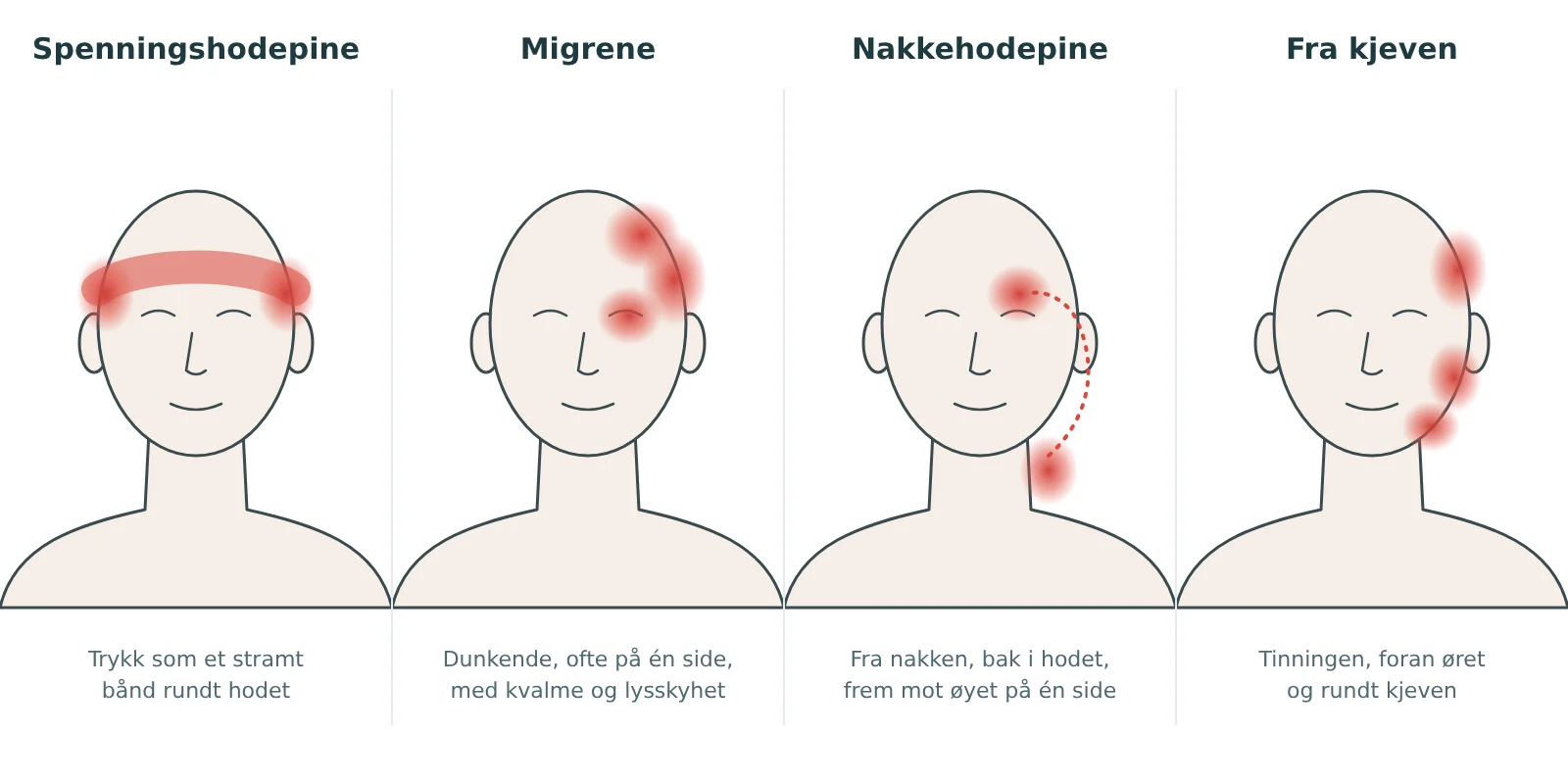 Fire hoder som viser hvor det gjør vondt ved spenningshodepine, migrene, nakkehodepine og hodepine fra kjeven
