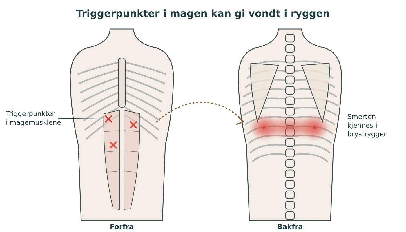 Illustrasjon av overkroppen forfra og bakfra: triggerpunkter øverst i magemusklene og et smerteområde på tvers av brystryggen