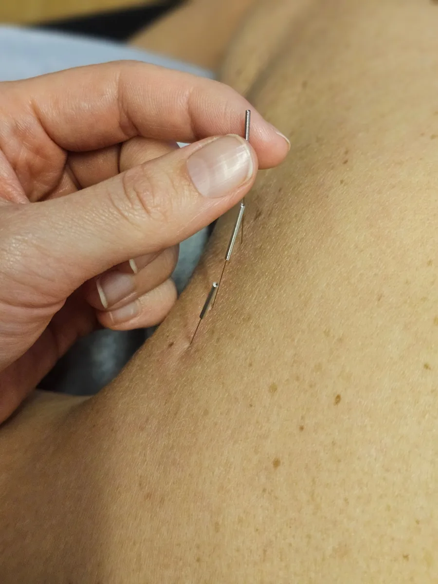 Tynne nåler i stramme muskler i nakken og skulderen under nålebehandling