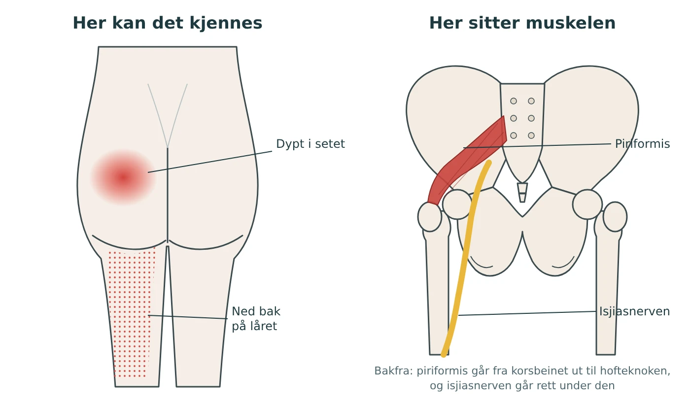 Illustrasjon av piriformis bakfra med isjiasnerven rett under, og hvor smerten kan kjennes dypt i setet og ned bak på låret