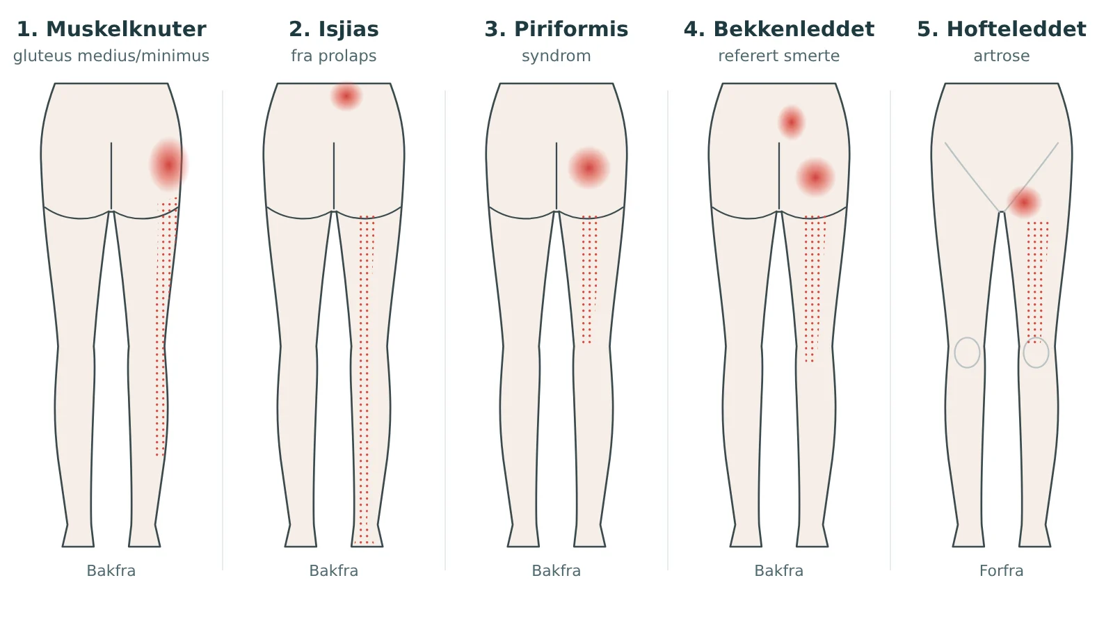 Fem smertekart på beina som viser hvor smerten kjennes ved muskelknuter i setet, isjias fra prolaps, piriformis syndrom, bekkenleddet og hofteleddet